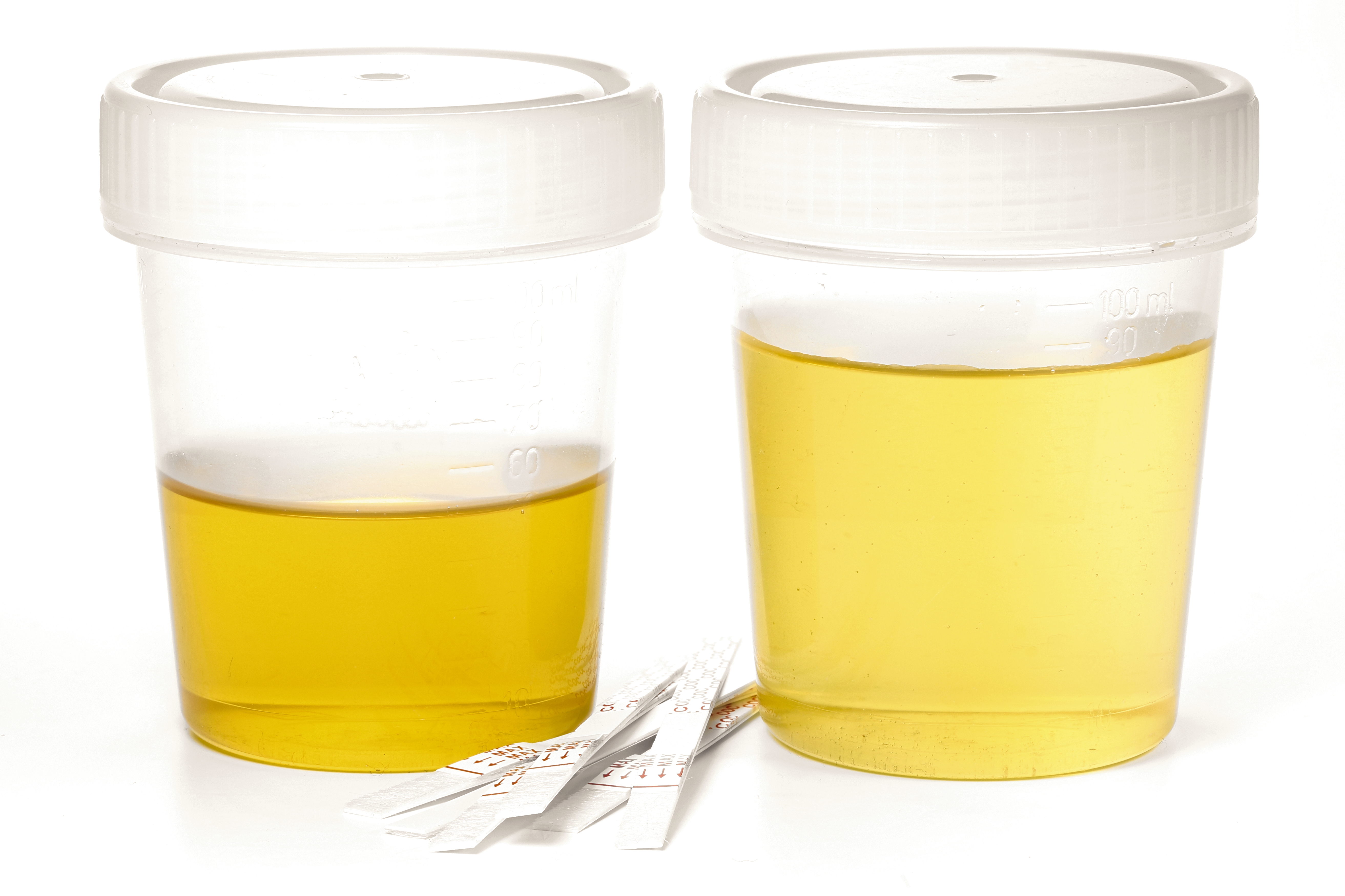 Urine samples in specimen cups