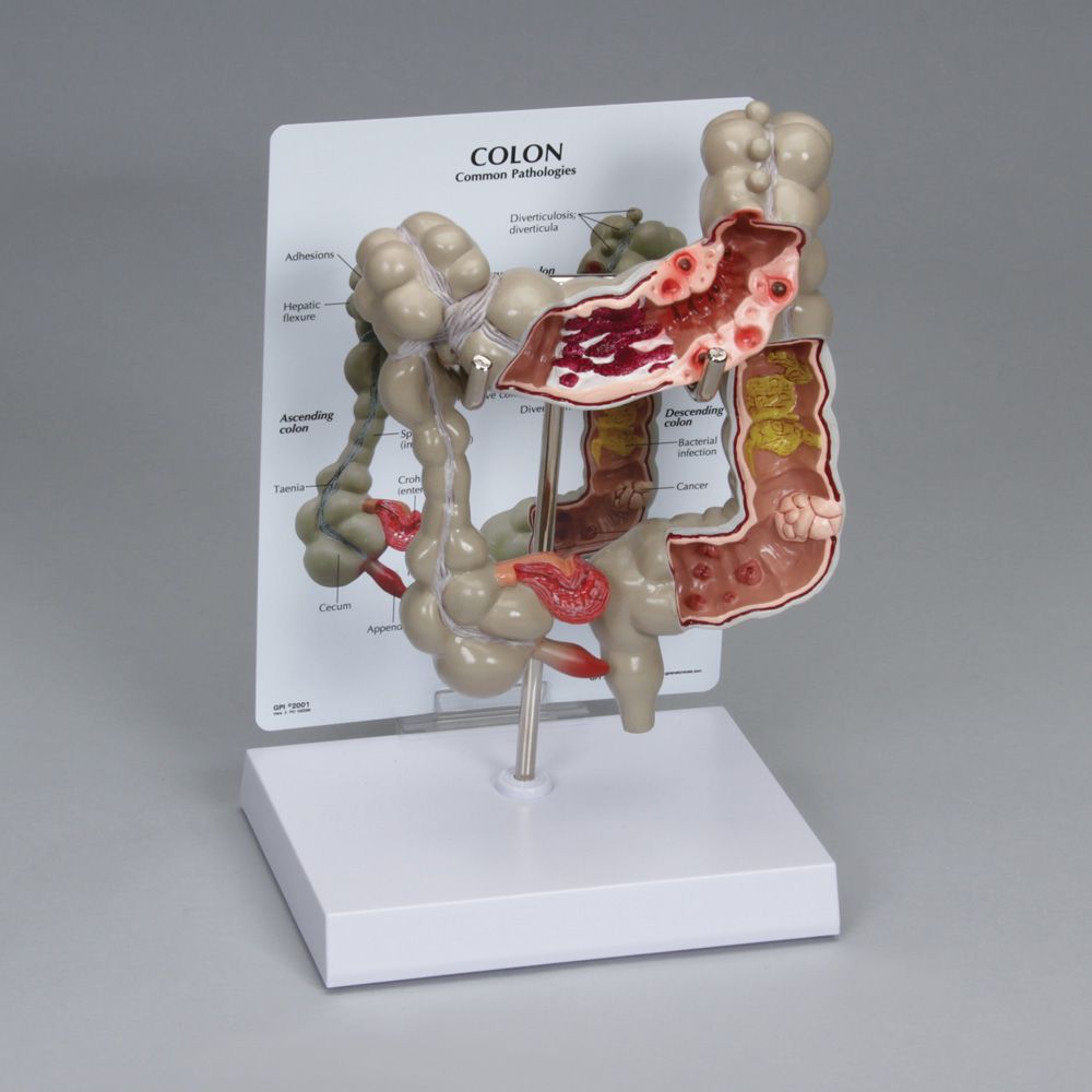 This 1/2× life size model shows common pathologies of the human colon. The ascending, transverse, descending, and sigmoid colon are depicted. Cross sections of the transverse, descending, and sigmoid colon show the following common pathologies: ulcerative colitis, diverticulitis, bacterial infection, cancer, polyps, and more.